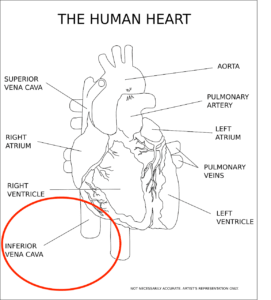 IVC filter lawsuit illustration of inferior vena cava